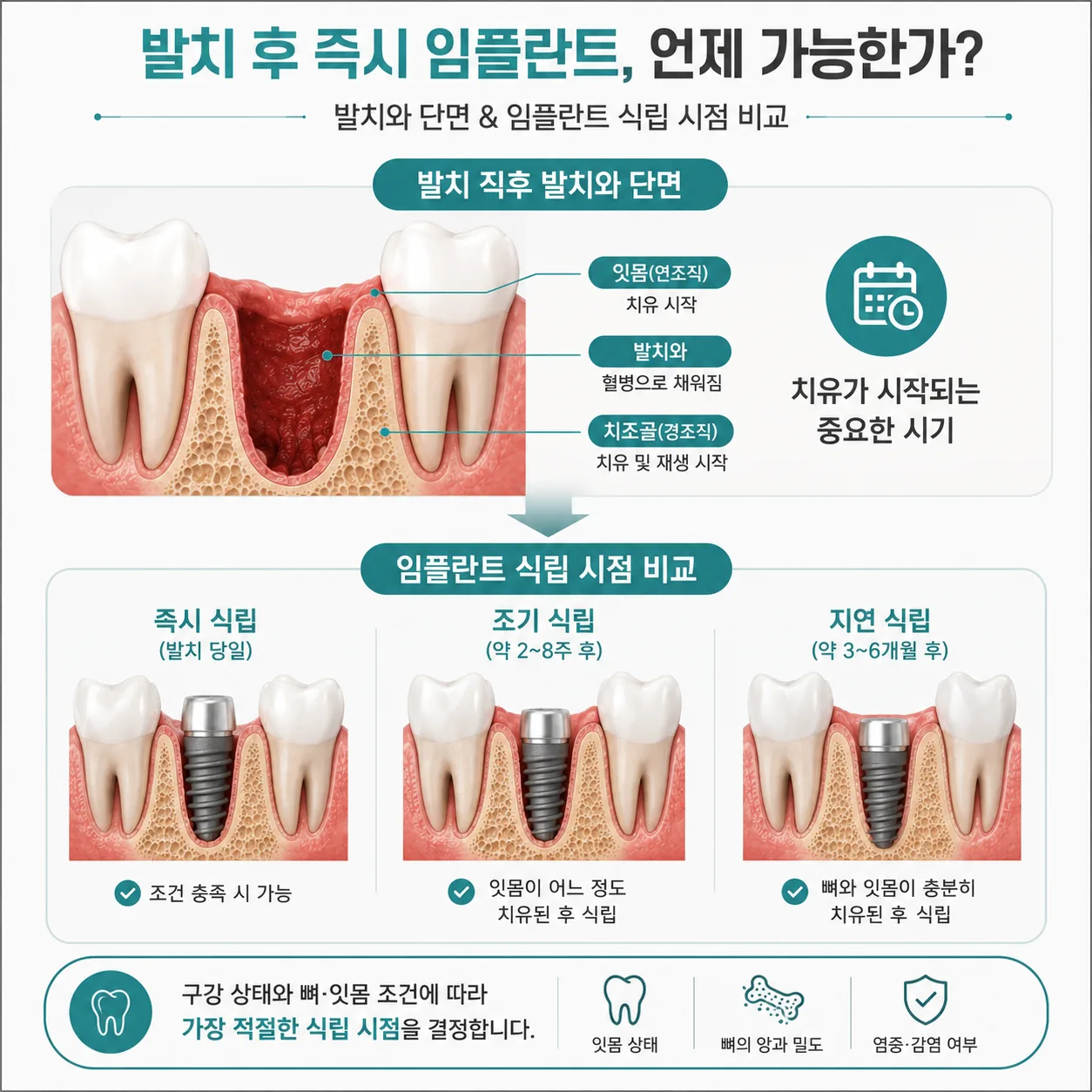 발치 후 임플란트 즉시식립과 지연식립 시점 비교 일러스트
