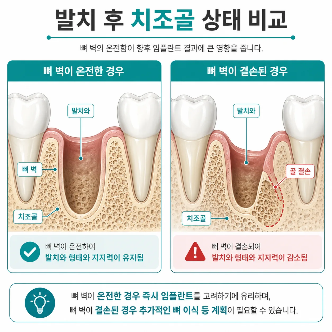 즉시식립 가능한 발치와와 뼈이식이 필요한 발치와 비교