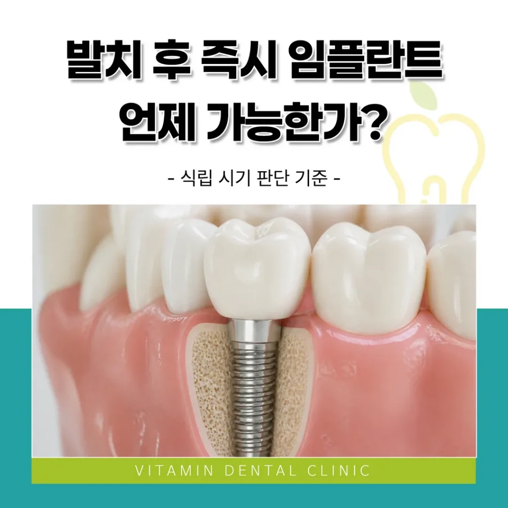 발치 후 즉시 임플란트, 언제 가능한가? 식립 시기 판단 기준(울산 중구)