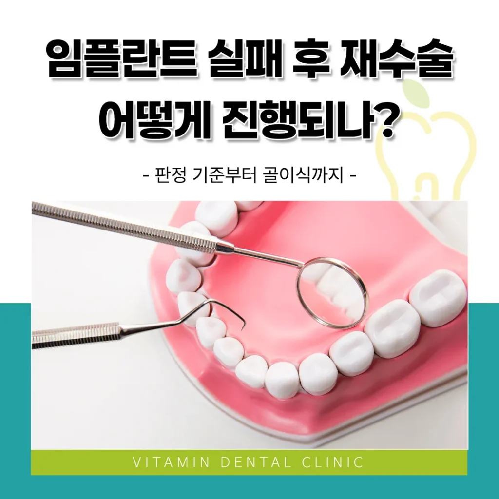 임플란트 실패 후 재수술, 어떻게 진행되나? 판정 기준부터 골이식까지 (울산 중구)