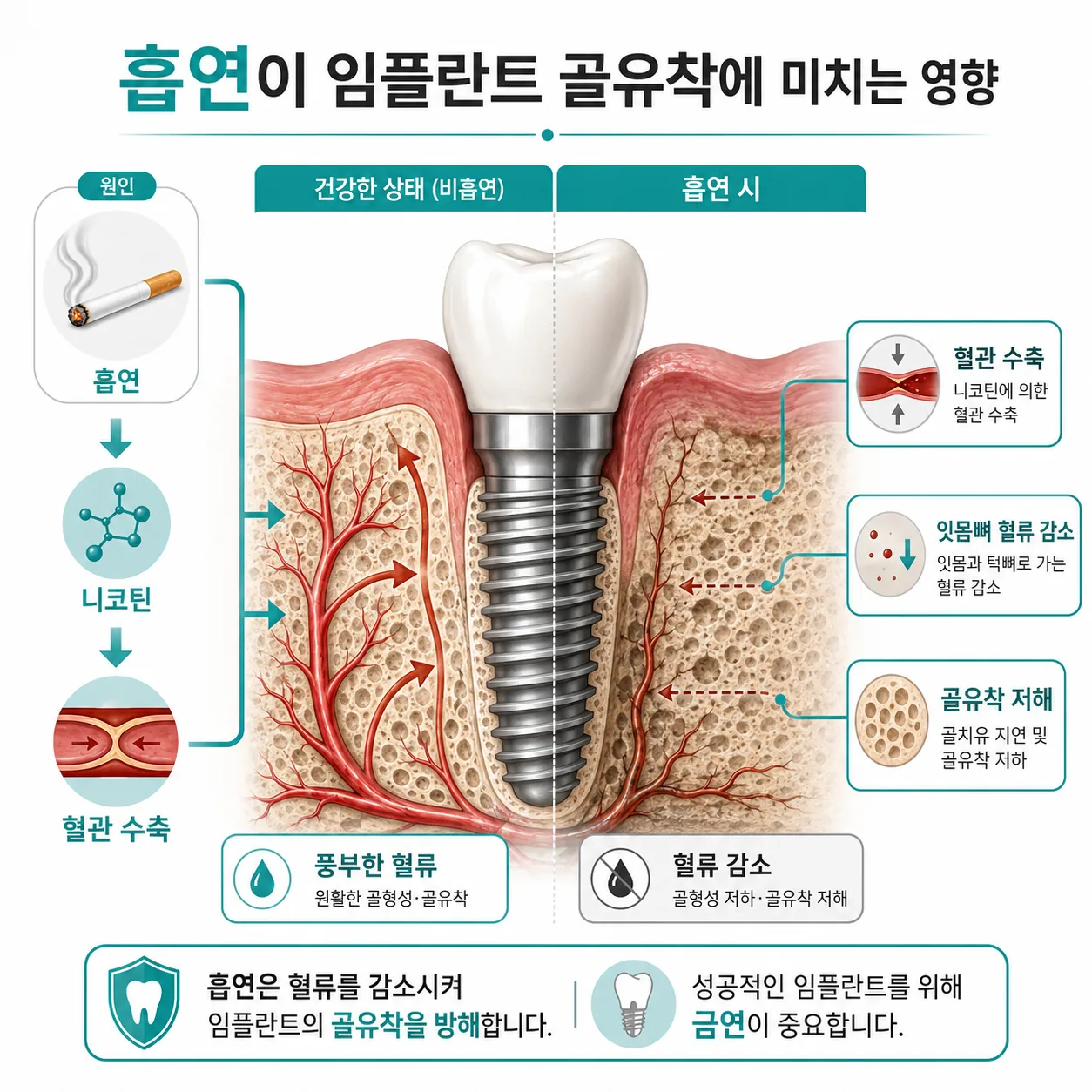 흡연이 임플란트 골유착과 잇몸뼈 혈류에 미치는 영향 개념도