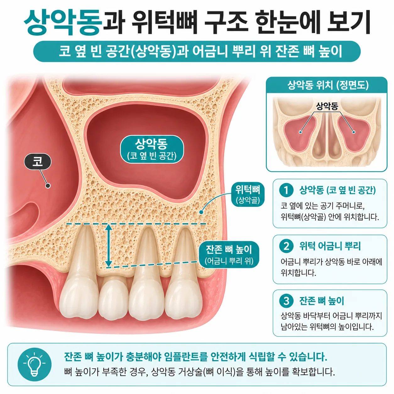 상악 임플란트에 영향을 주는 상악동 위치와 잔존 골 높이 모식도