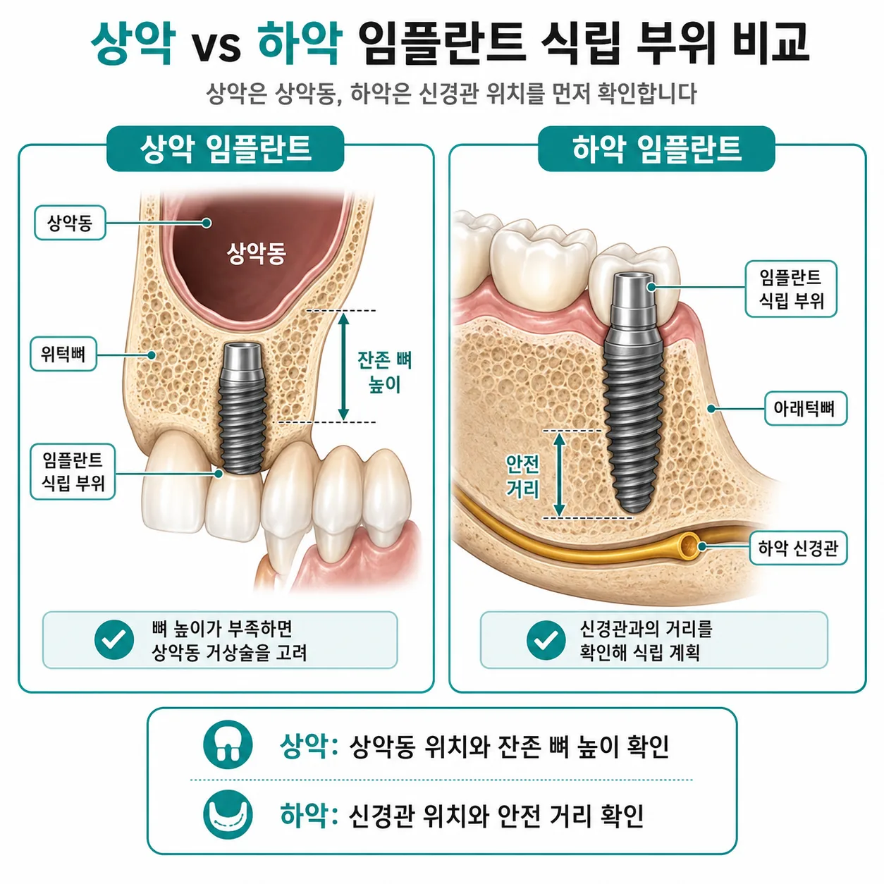 상악 임플란트와 하악 임플란트의 해부학적 차이 비교 일러스트