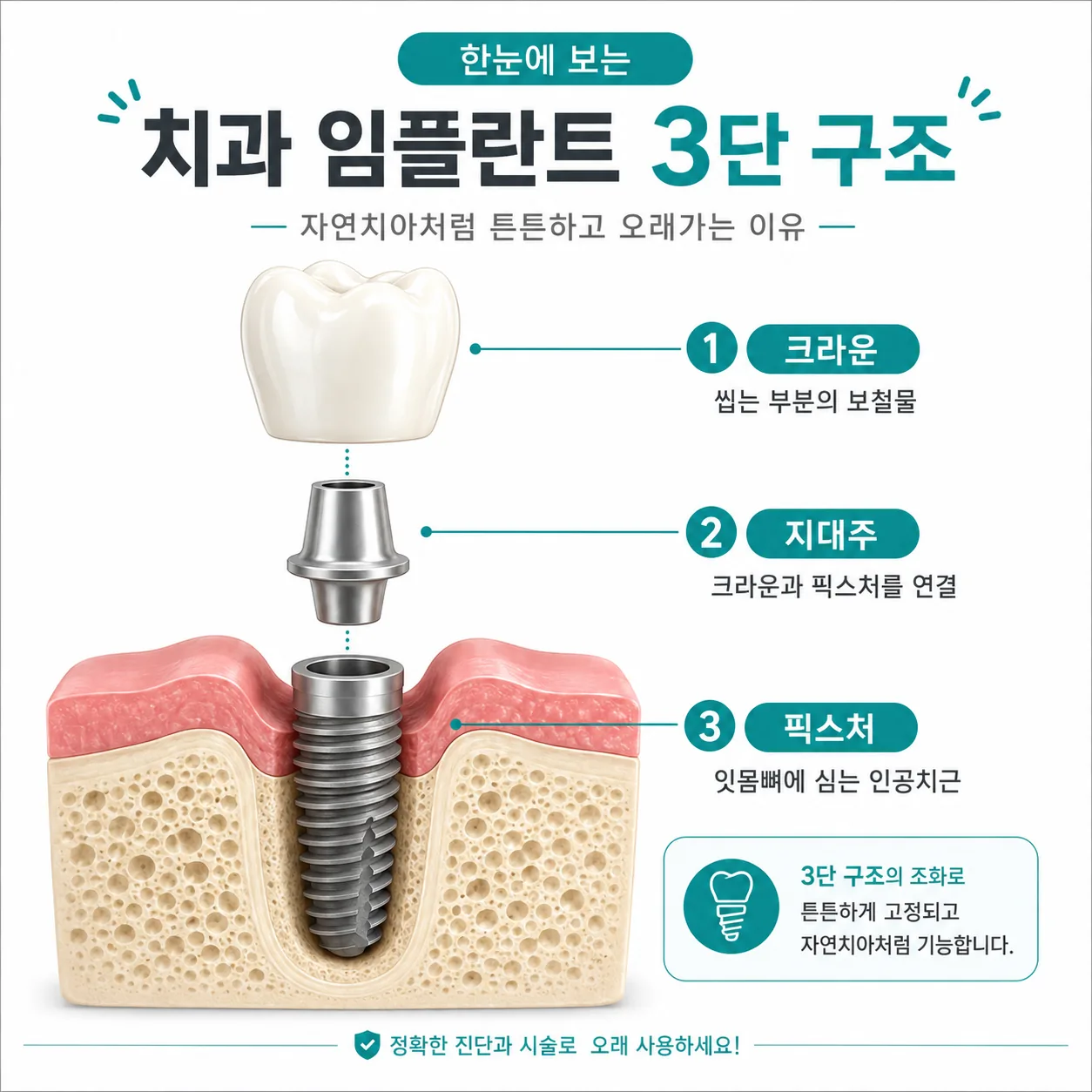 임플란트 흔들림의 원인 부위를 구분하기 위한 크라운·지대주·픽스처 3층 구조 단면도