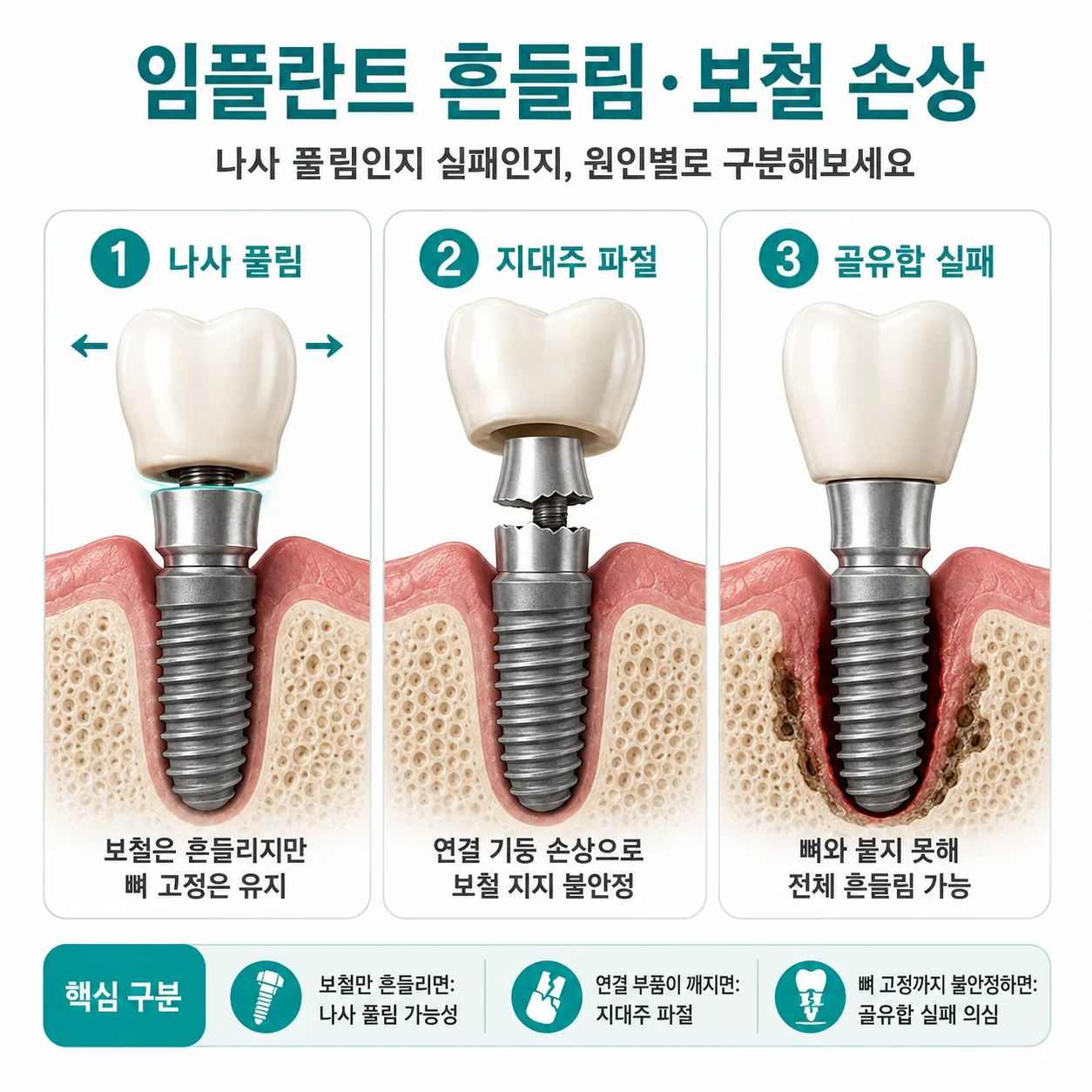 보철 나사 풀림과 지대주 문제, 픽스처 골유합 실패를 비교한 임플란트 흔들림 원인 3가지