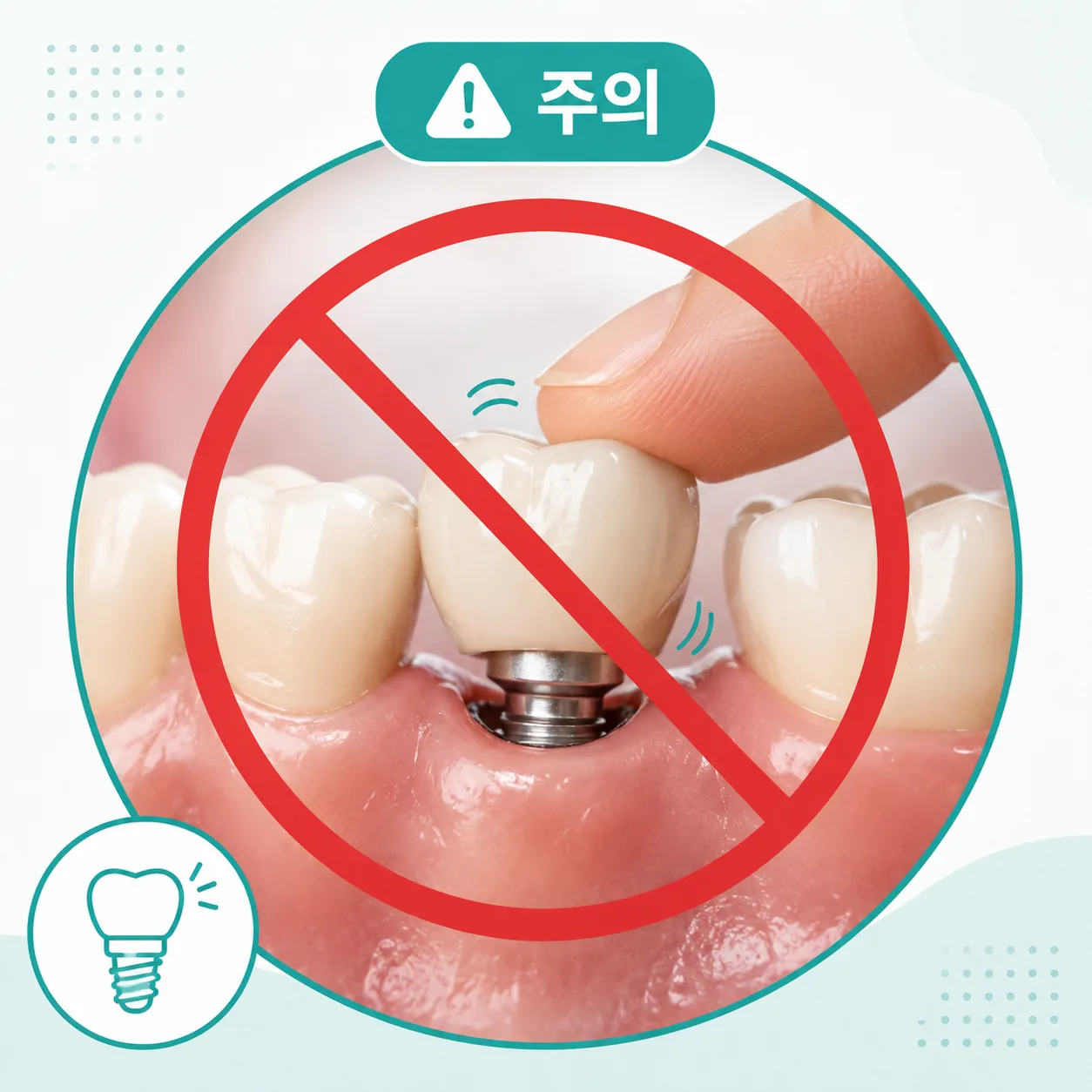 임플란트 흔들림 발생 시 손으로 조이는 자가 조치 금지 안내