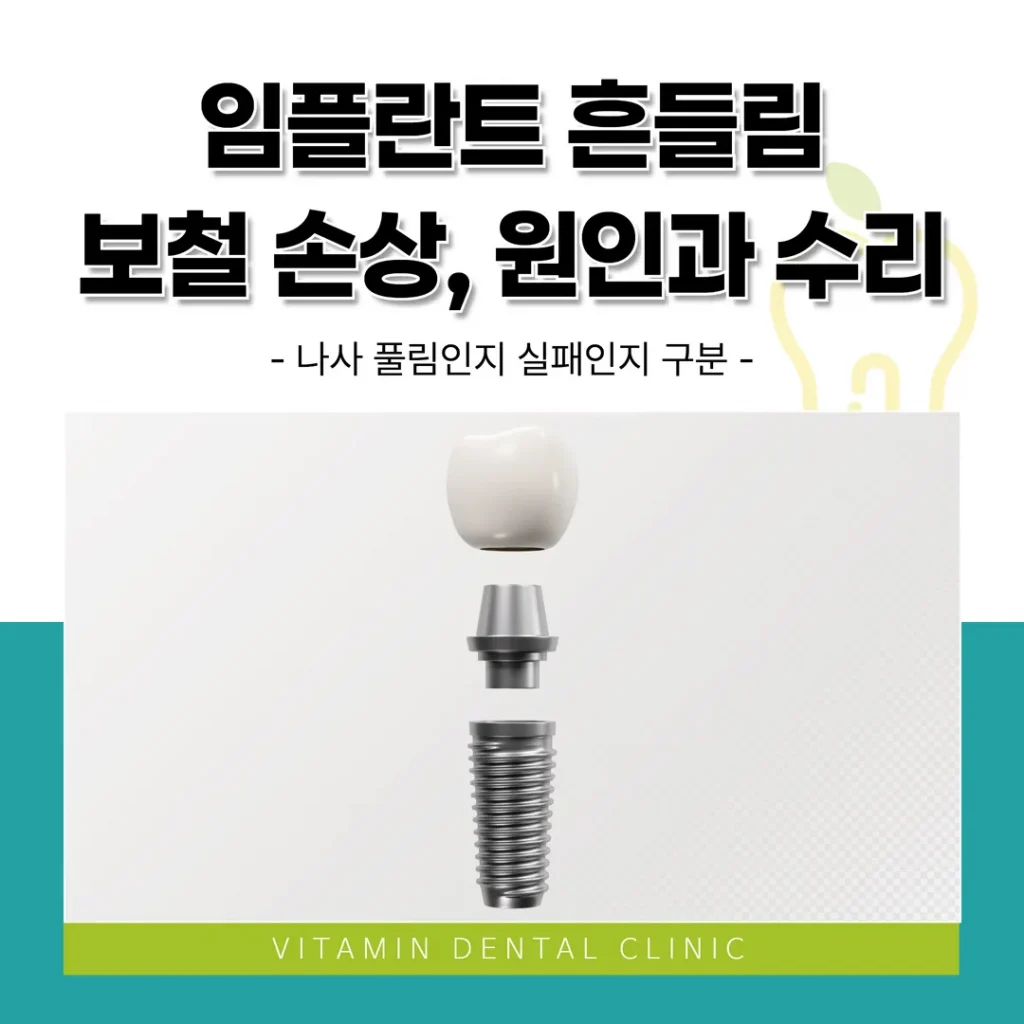 임플란트 흔들림·보철 손상, 원인과 수리 — 나사 풀림인지 실패인지 구분 (울산 중구)