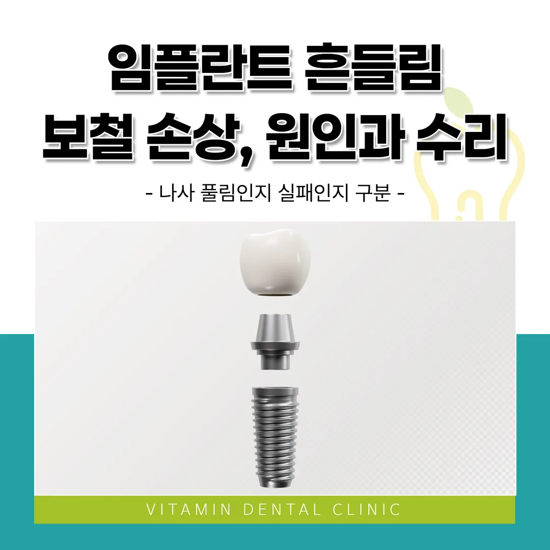 임플란트 흔들림·보철 손상, 원인과 수리 — 나사 풀림인지 실패인지 구분 (울산 중구)