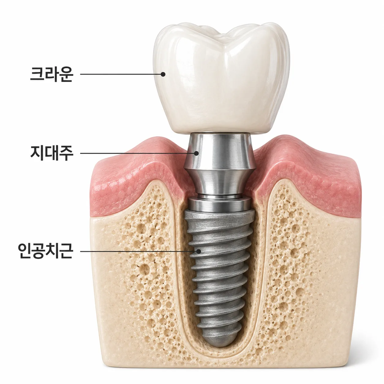 임플란트 구조를 보여주는 인공치근·지대주·크라운 단면 일러스트