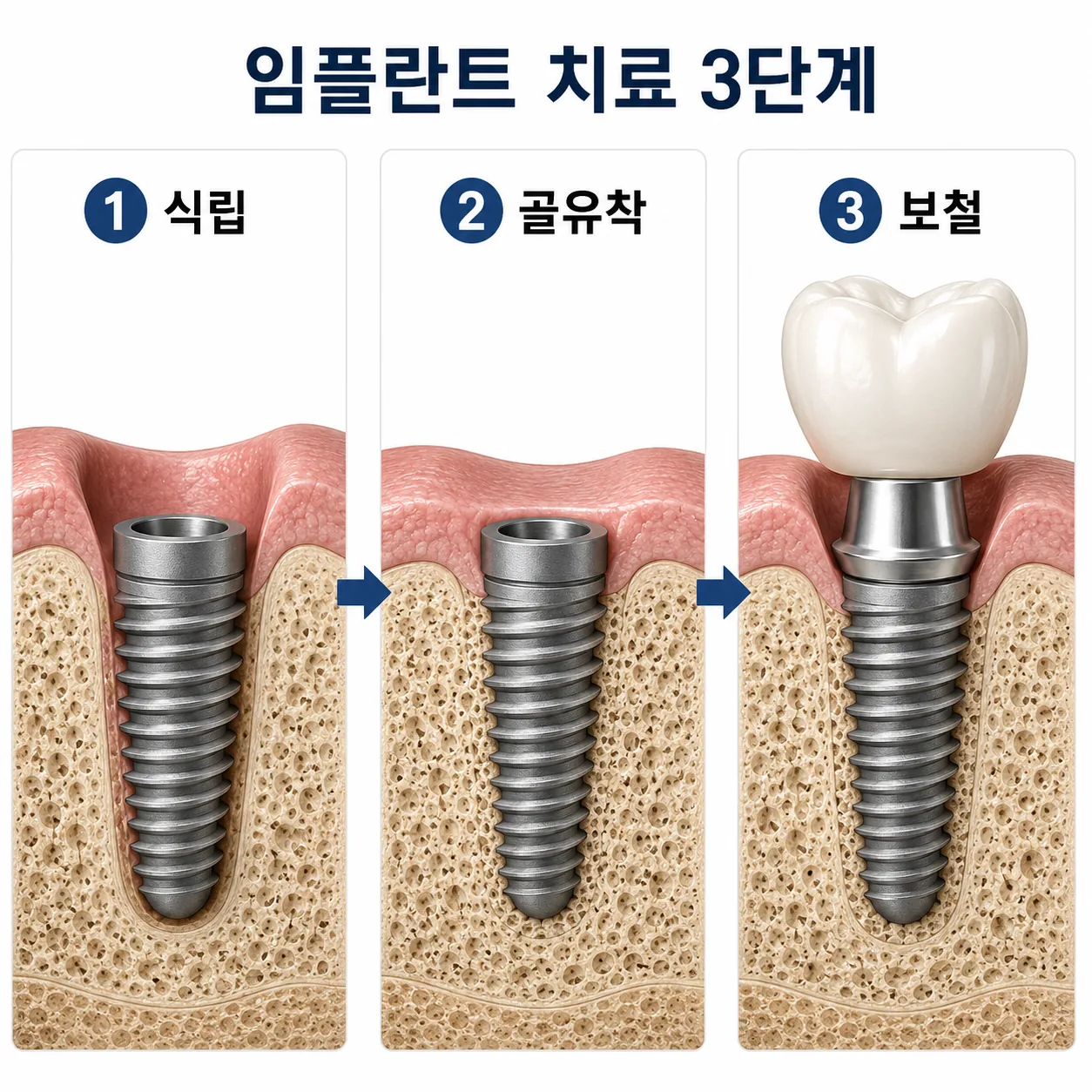 임플란트 치료 3단계 식립·골유착·보철 과정을 보여주는 도식