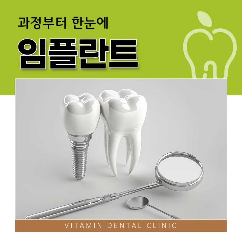 울산 중구 임플란트, 과정부터 한눈에