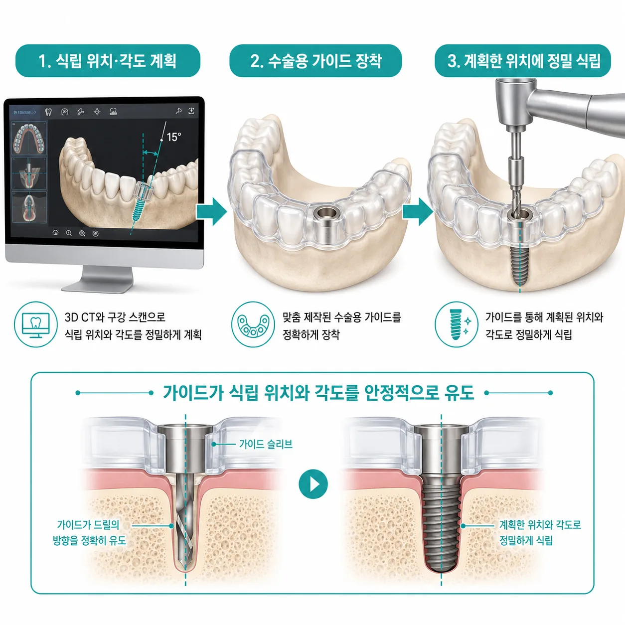 울산 중구 네비게이션 임플란트 수술용 가이드 정밀 식립