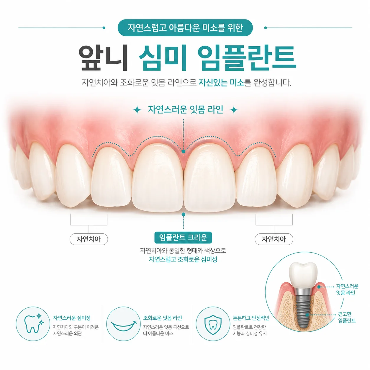 울산 중구 앞니 심미 임플란트 자연스러운 잇몸라인