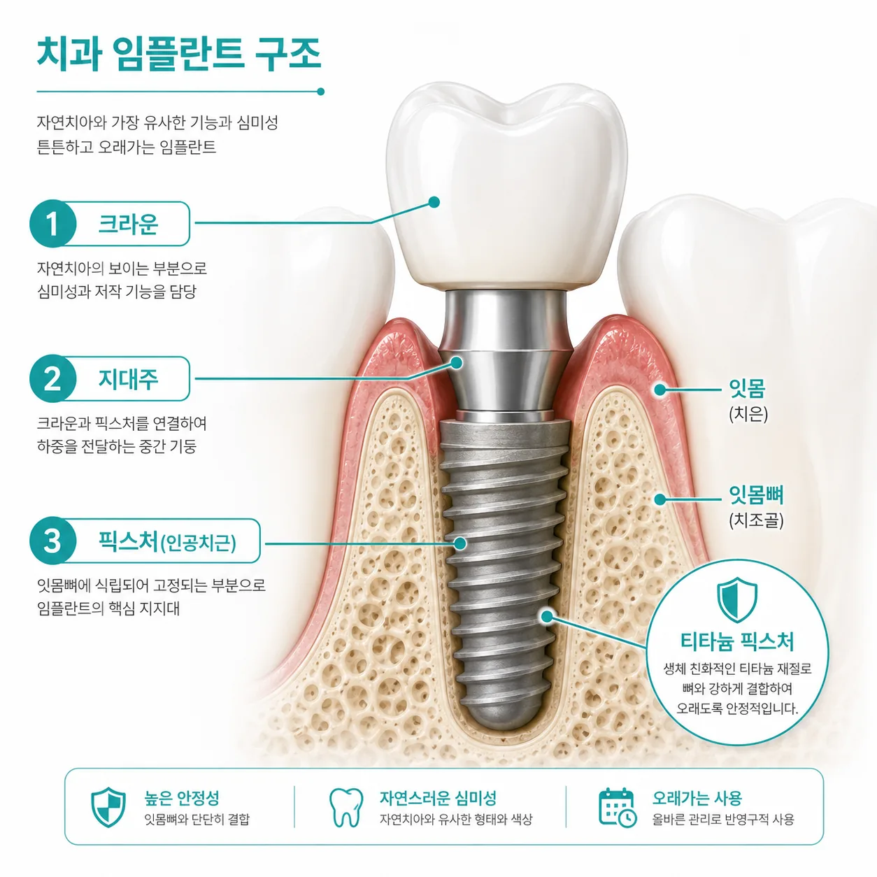 임플란트 종류와 재료를 이해하기 위한 픽스처 구조 단면도