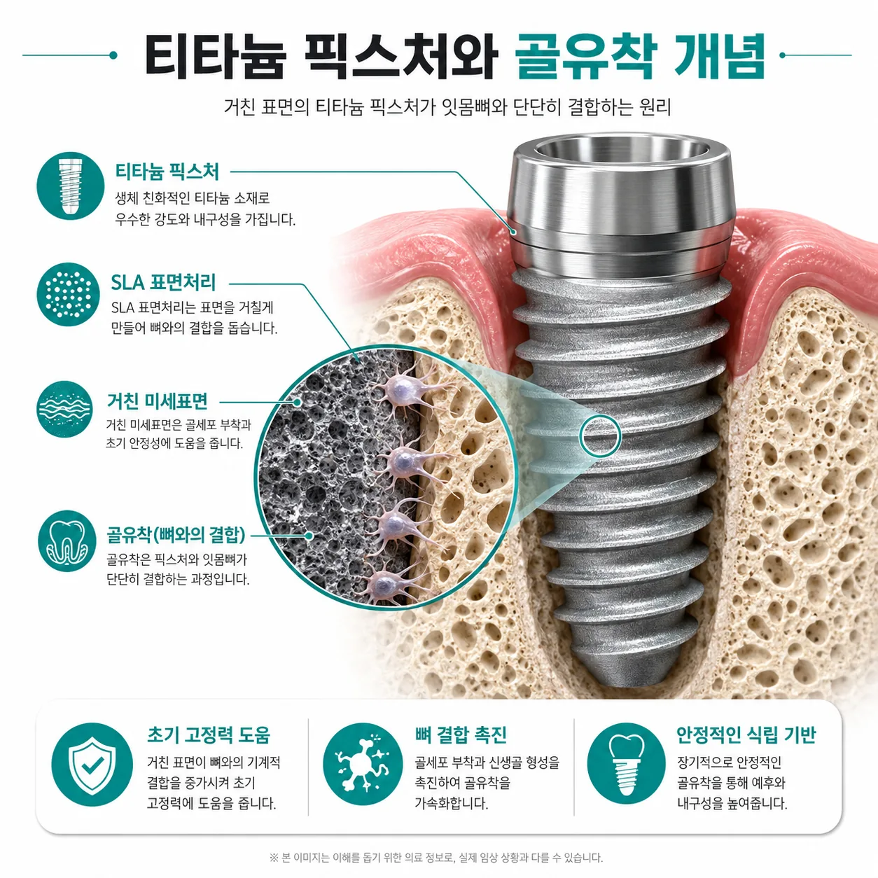 임플란트 재료 티타늄 픽스처 표면처리와 골유착 개념도