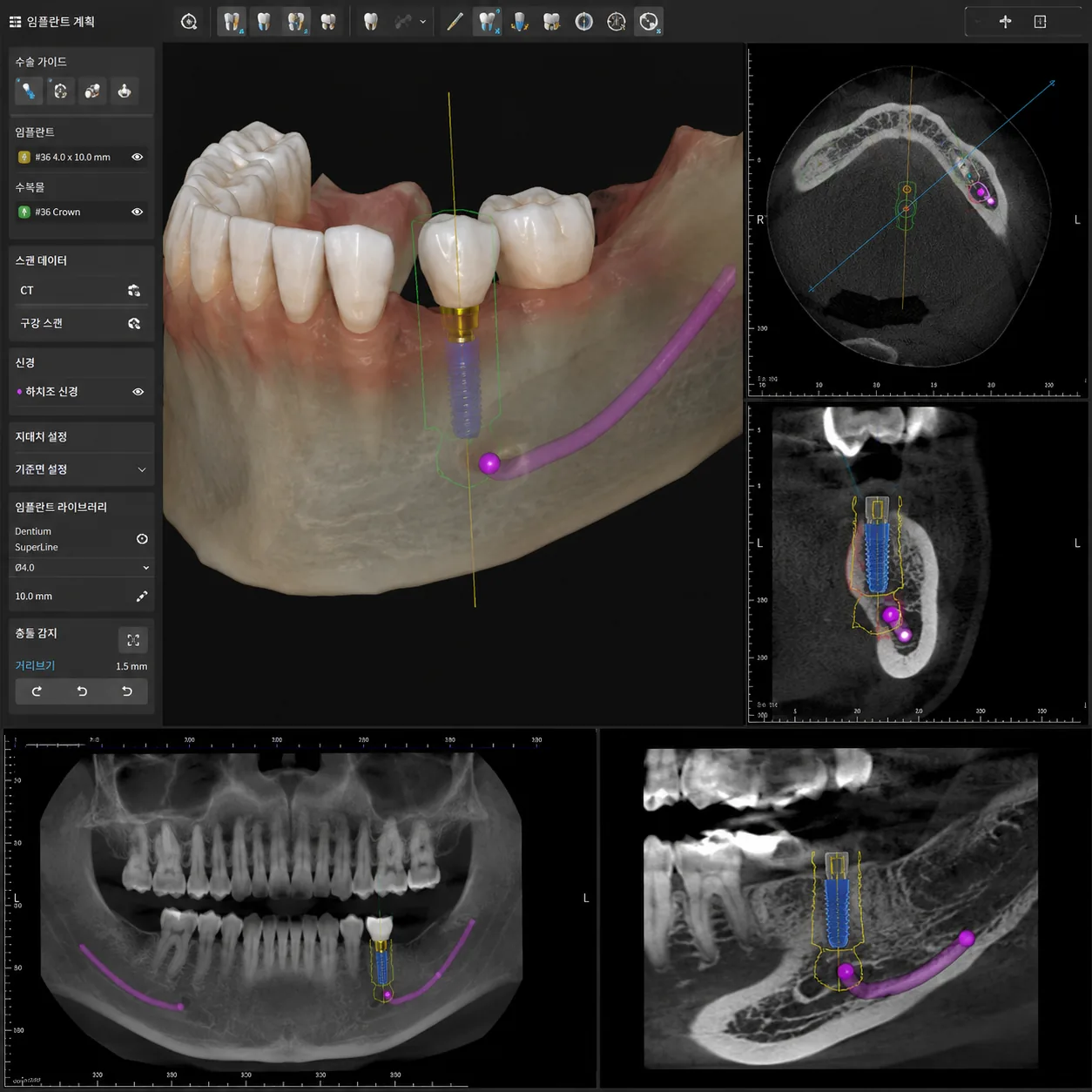 네비게이션 임플란트 3D CT 디지털 모의수술 화면