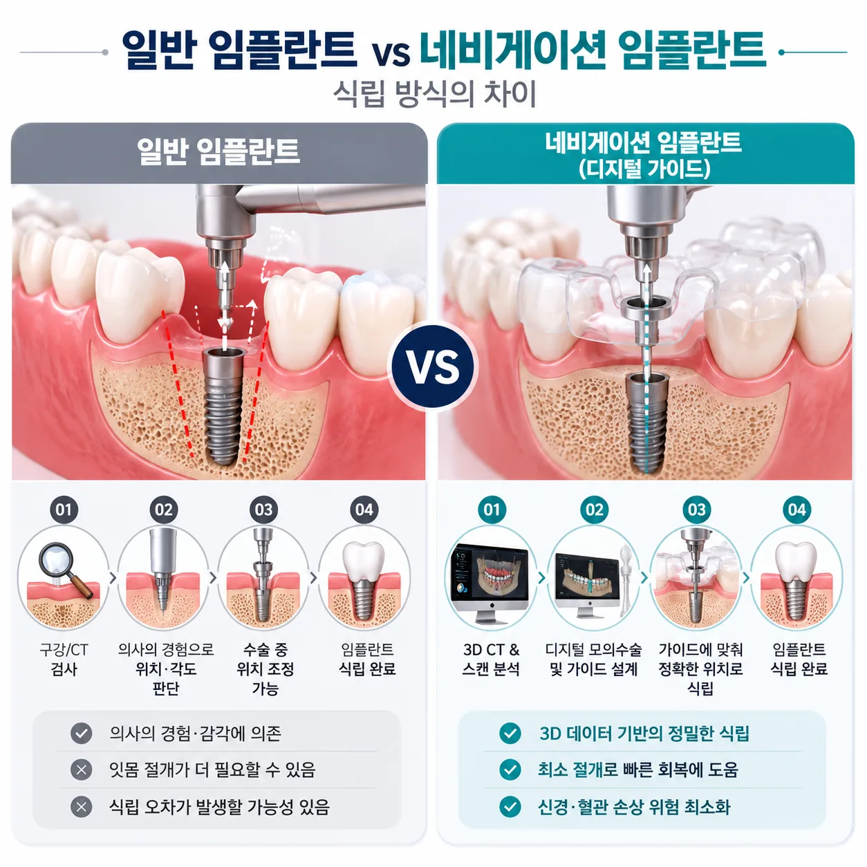 일반 임플란트와 네비게이션 임플란트 식립 방식 비교
