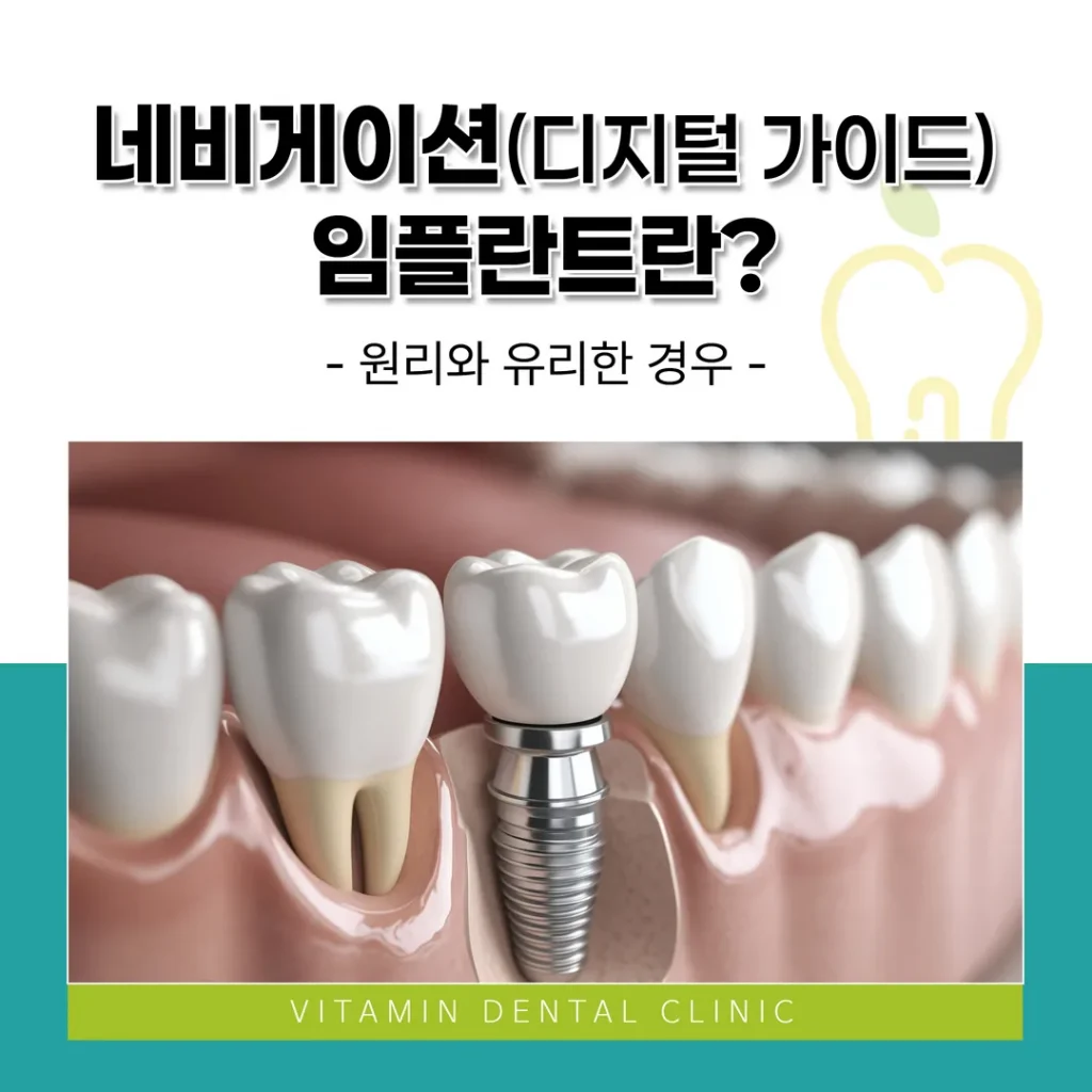 네비게이션(디지털 가이드) 임플란트란? 원리와 유리한 경우 (울산 중구)