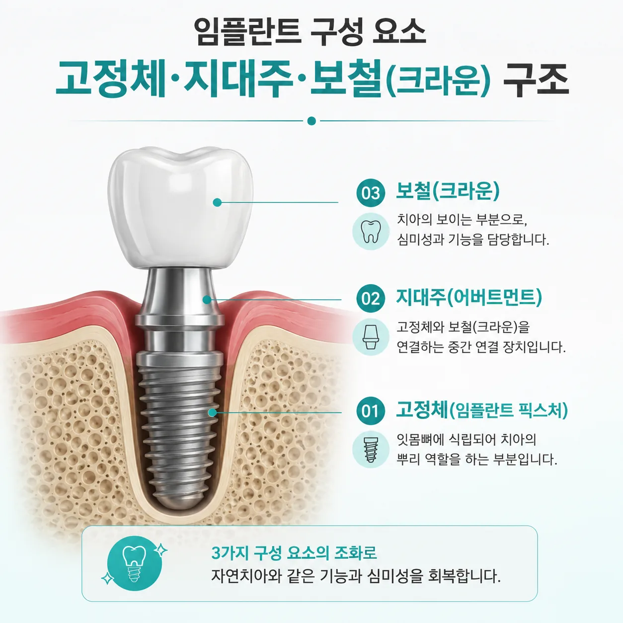 임플란트 구성 요소 고정체 지대주 보철 크라운 구조