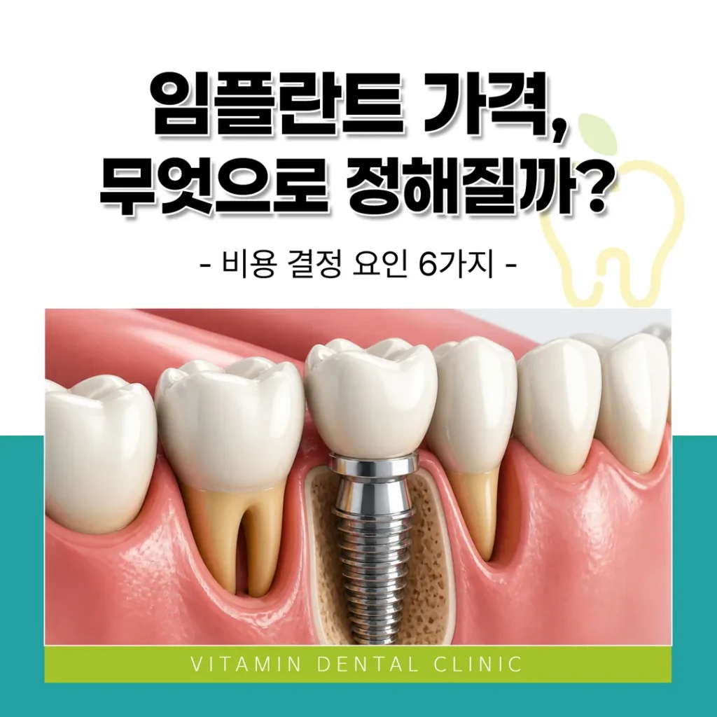 임플란트 가격, 무엇으로 정해질까? 비용 결정 요인 6가지 (울산 중구)