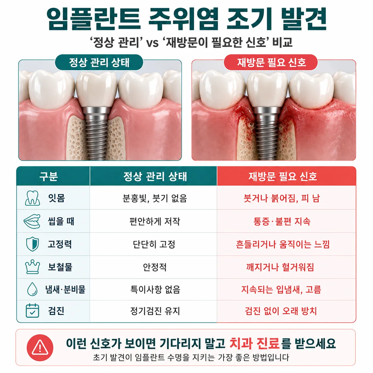 임플란트 주위염 재방문 필요 신호 비교