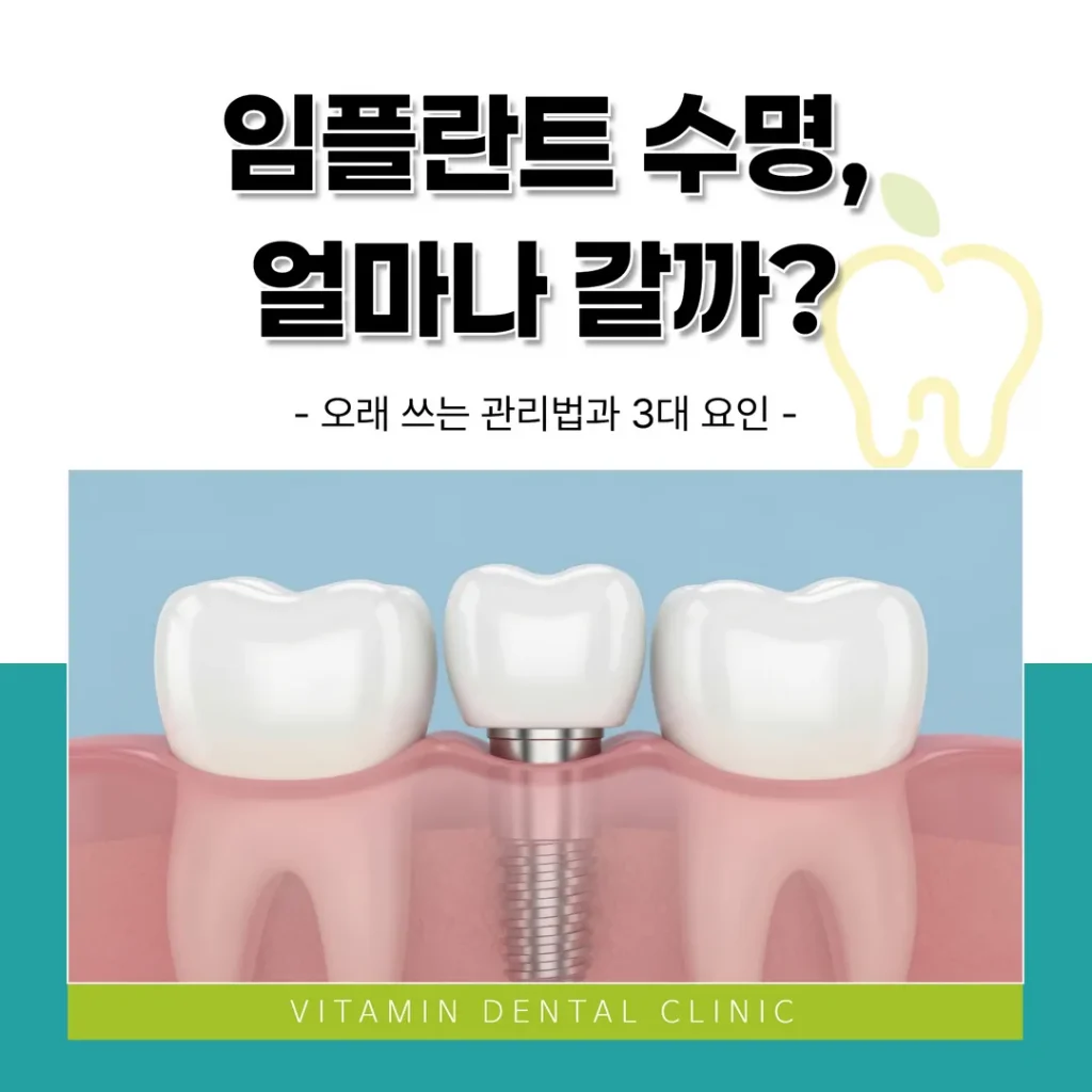 임플란트 수명, 얼마나 갈까? 오래 쓰는 관리법과 3대 요인 (울산 중구)