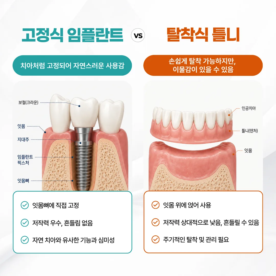 고정식 임플란트와 탈착식 틀니의 구조 차이