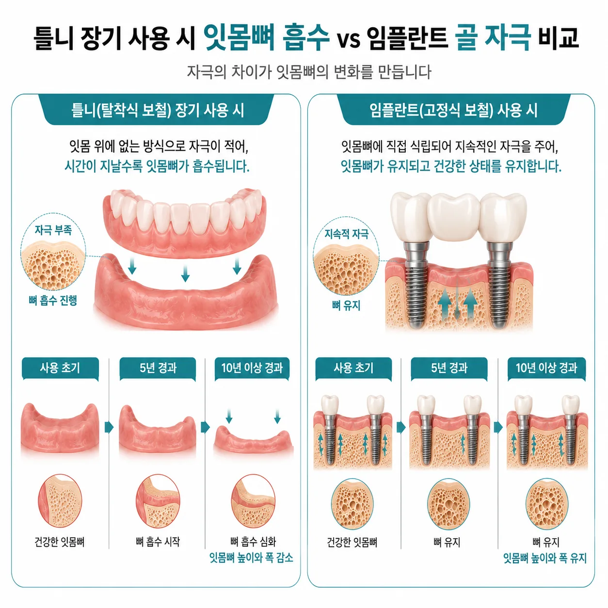 틀니 장기 사용 시 잇몸뼈 흡수와 임플란트 골 자극 비교