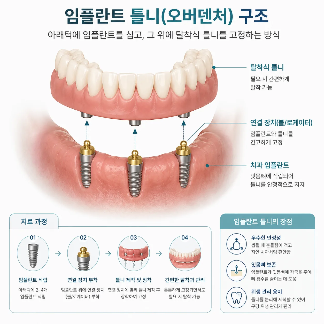임플란트 틀니 오버덴처 구조 - 울산 중구 비타민치과