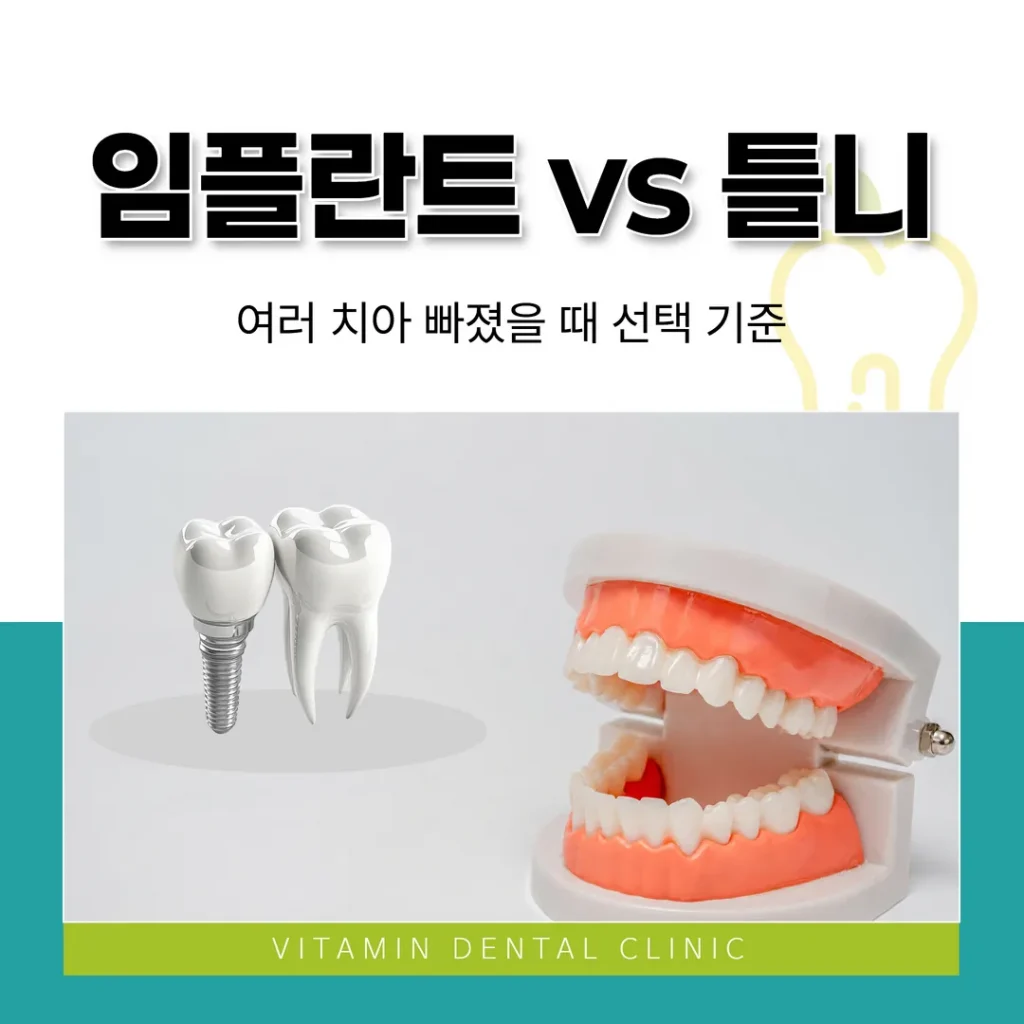 임플란트 vs 틀니, 여러 치아 빠졌을 때 선택 기준(울산 중구)