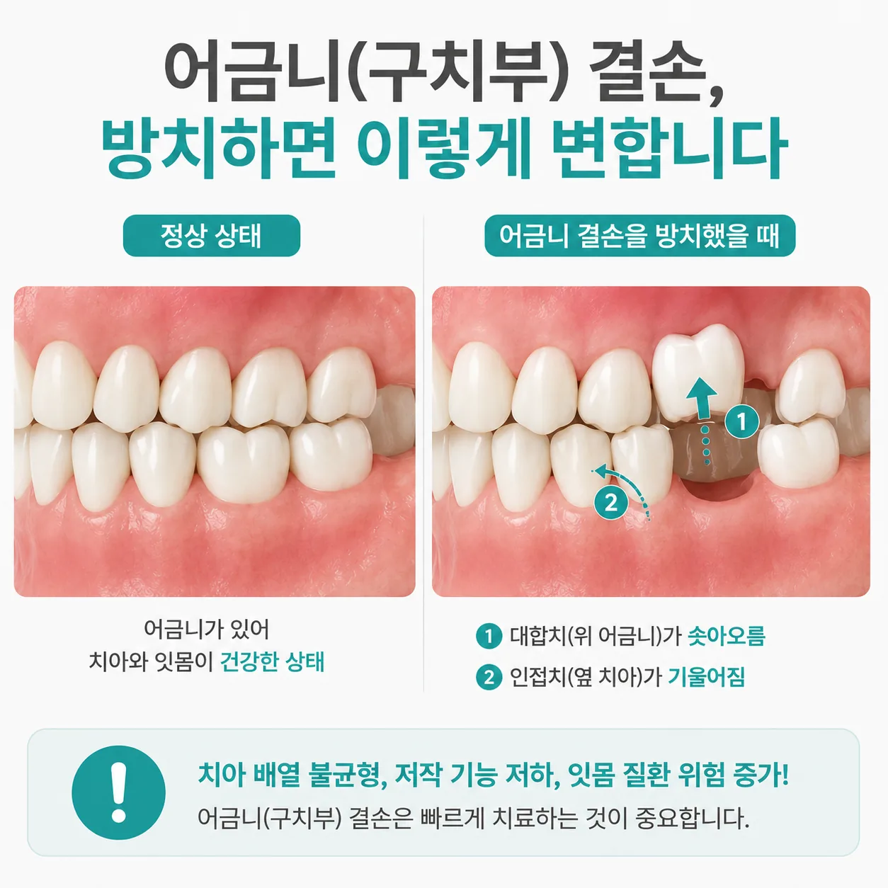 어금니 상실 방치 시 인접치 이동과 대합치 정출 변화
