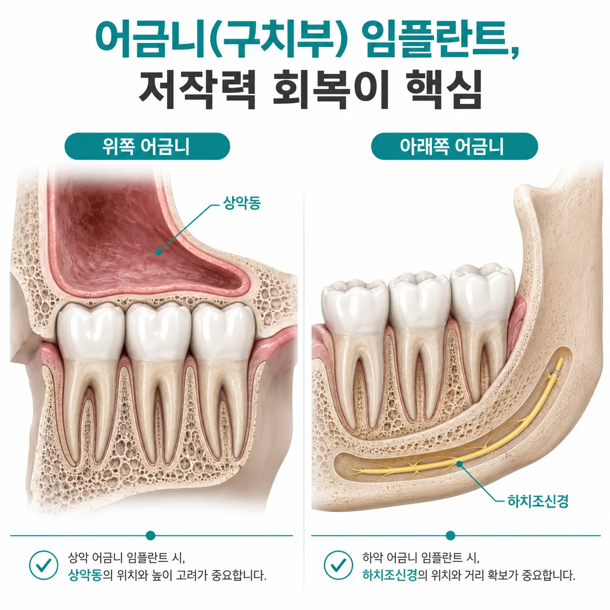 상악동과 하치조신경 위치를 비교한 어금니 임플란트 해부 일러스트