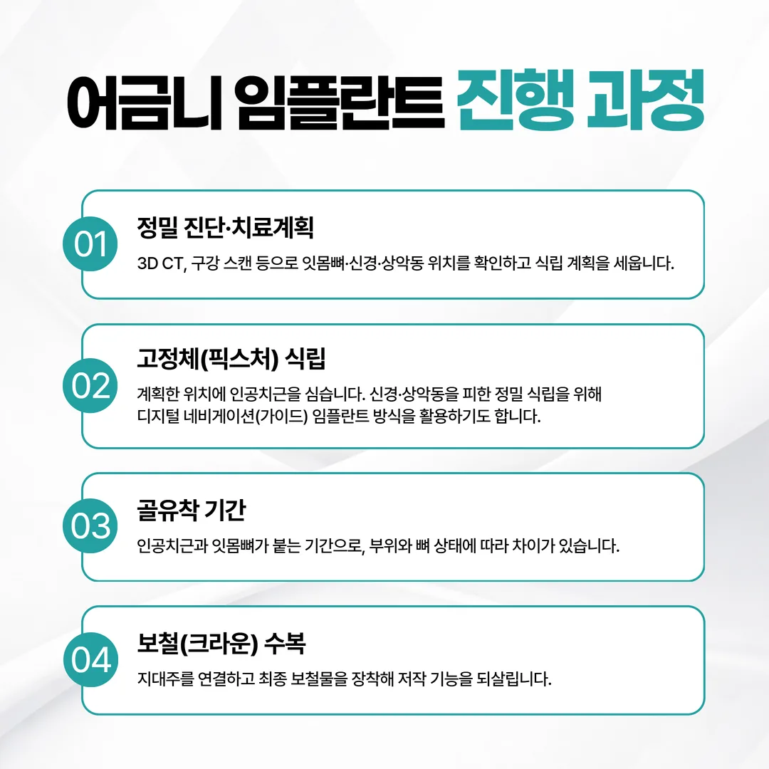 어금니 임플란트 진행 과정을 단계별로 나타낸 다이어그램