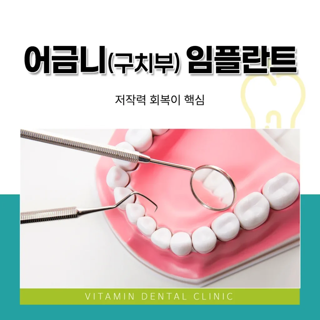 어금니(구치부) 임플란트, 저작력 회복이 핵심 (울산 중구)