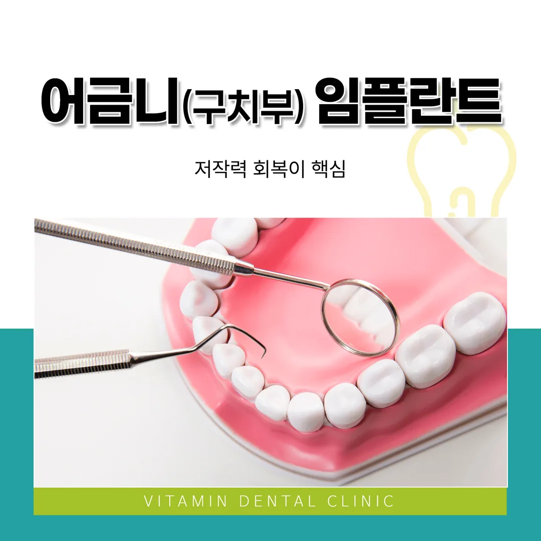 어금니(구치부) 임플란트, 저작력 회복이 핵심 (울산 중구)