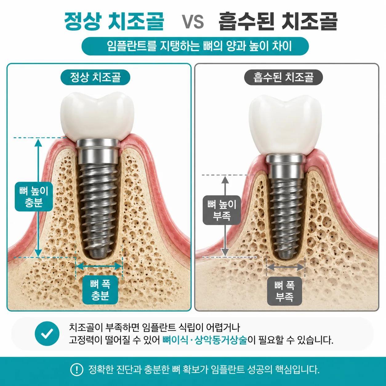 잇몸뼈 흡수로 임플란트 식립에 필요한 치조골 폭과 높이가 부족해진 상태 비교