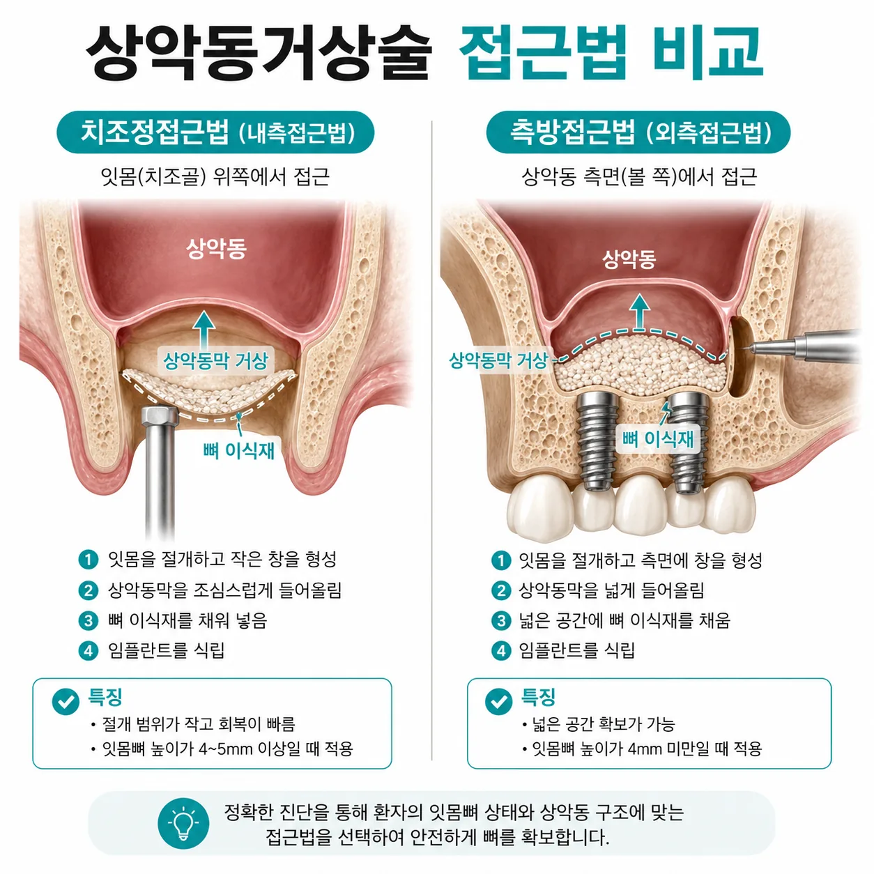 상악동거상술 치조정접근법과 측방접근법 비교 도해