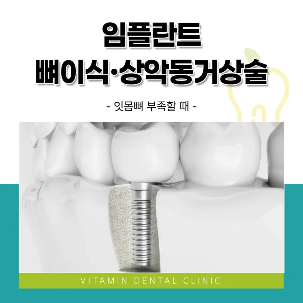임플란트 뼈이식·상악동거상술, 잇몸뼈 부족할 때 (울산 중구)