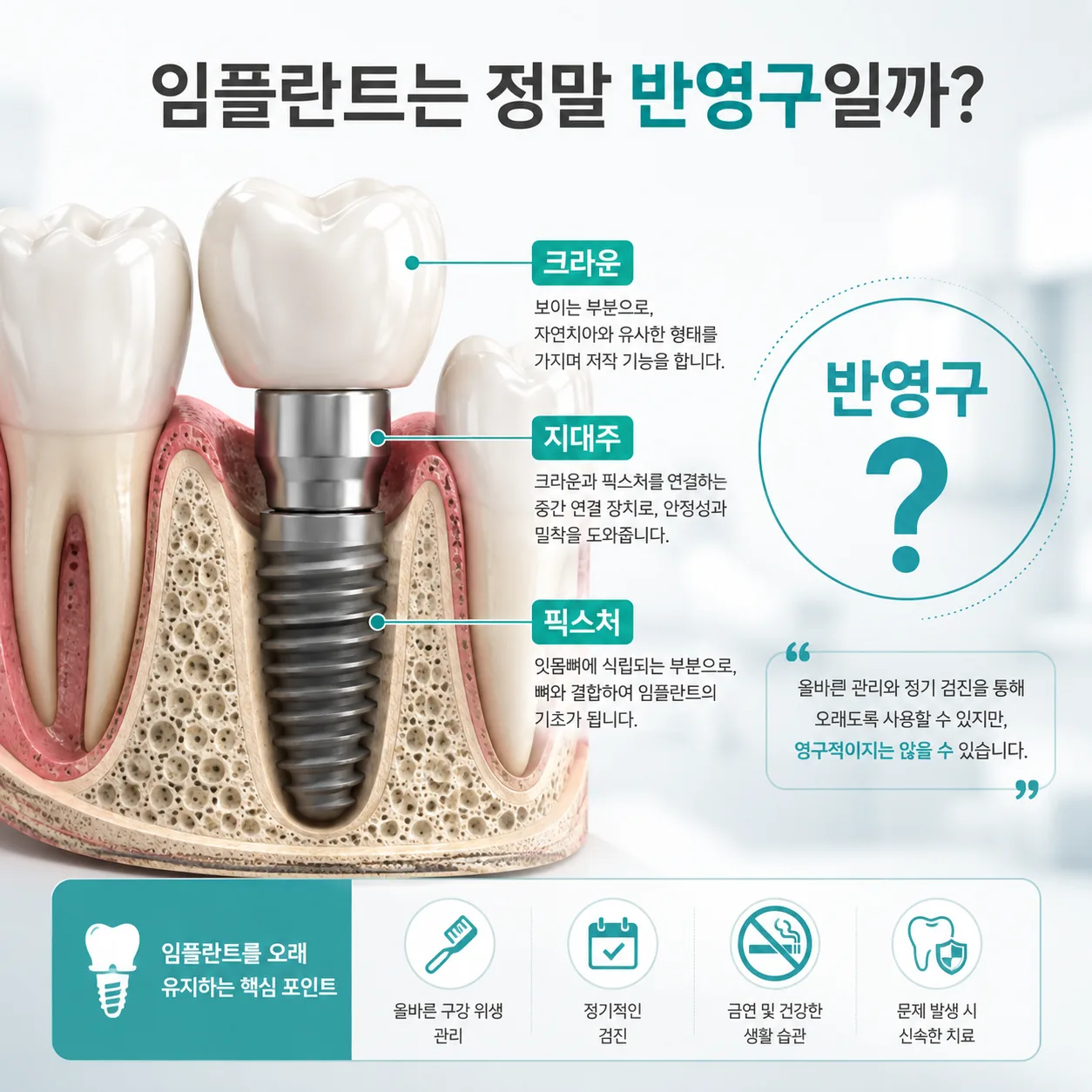 임플란트 반영구 오해와 진실을 설명하는 임플란트 구조 단면 일러스트
