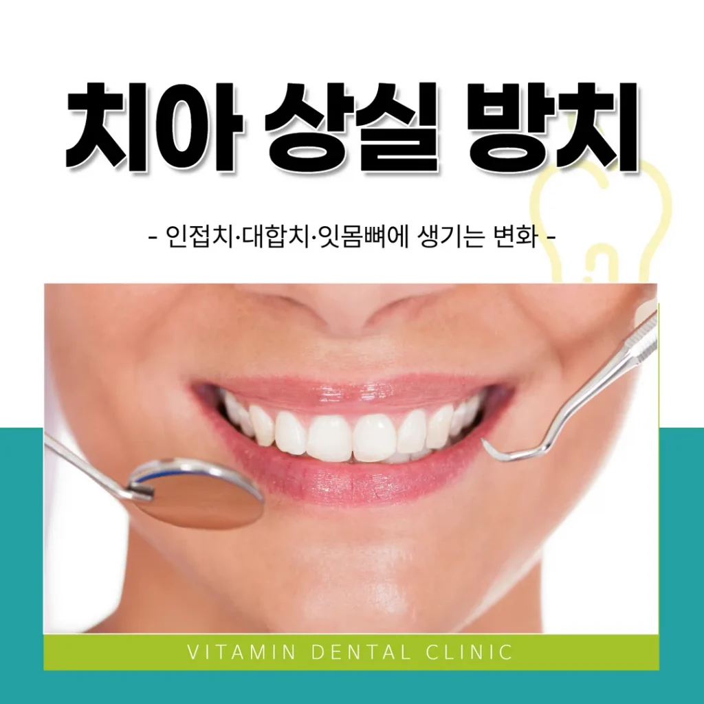 치아 상실 방치 — 인접치·대합치·잇몸뼈에 생기는 변화