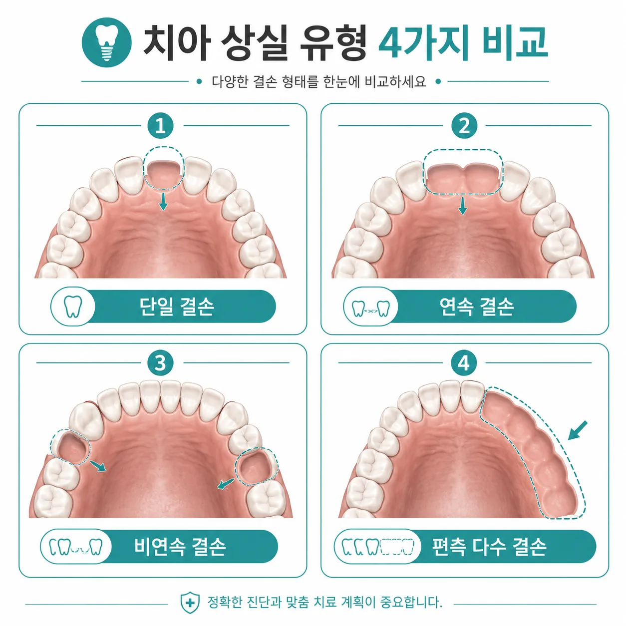 결손 패턴별 임플란트 개수 설계 비교 일러스트