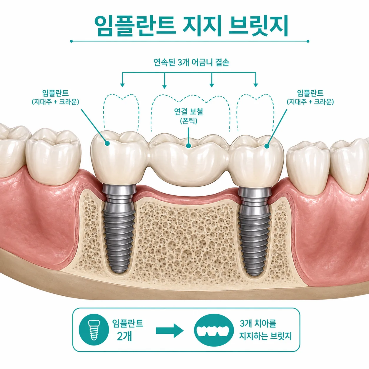 연속 결손 부위의 임플란트 지지 브릿지 설계 모식도