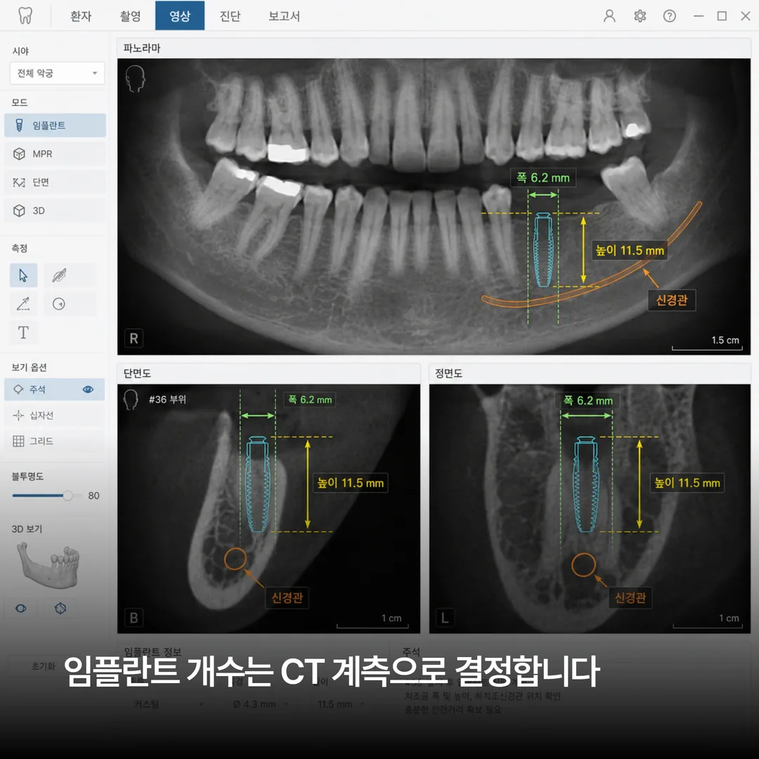 임플란트 개수 설계를 위한 CT 계측 화면