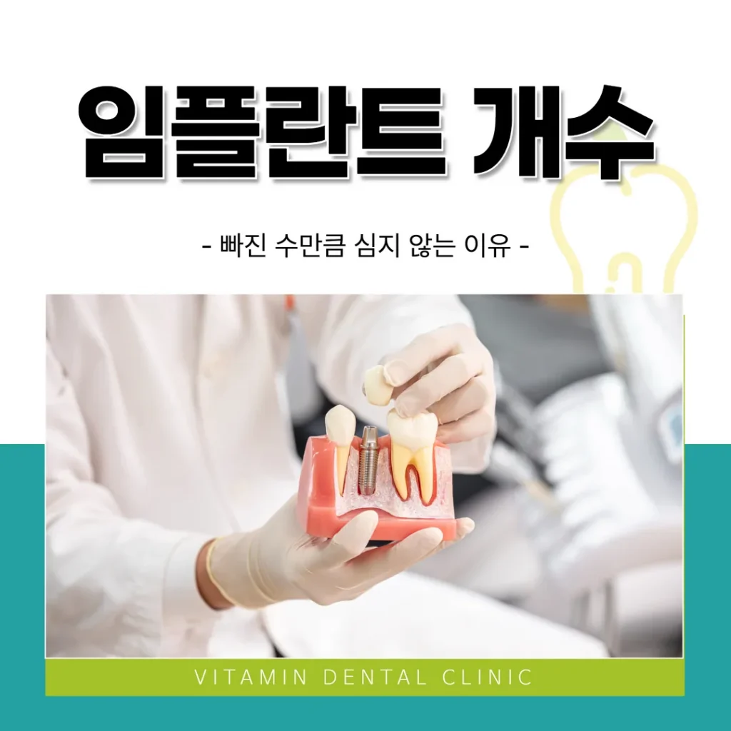 임플란트 개수, 빠진 수만큼 심지 않는 이유 (울산 중구)