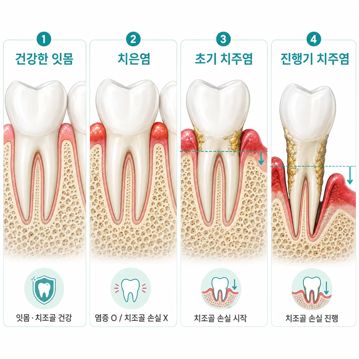 치주염 단계별 잇몸과 치조골 변화 비교