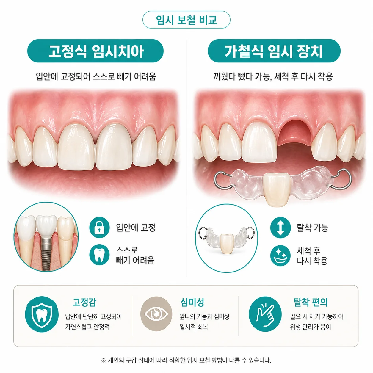 고정식 임시치아와 가철식 임시 장치 비교