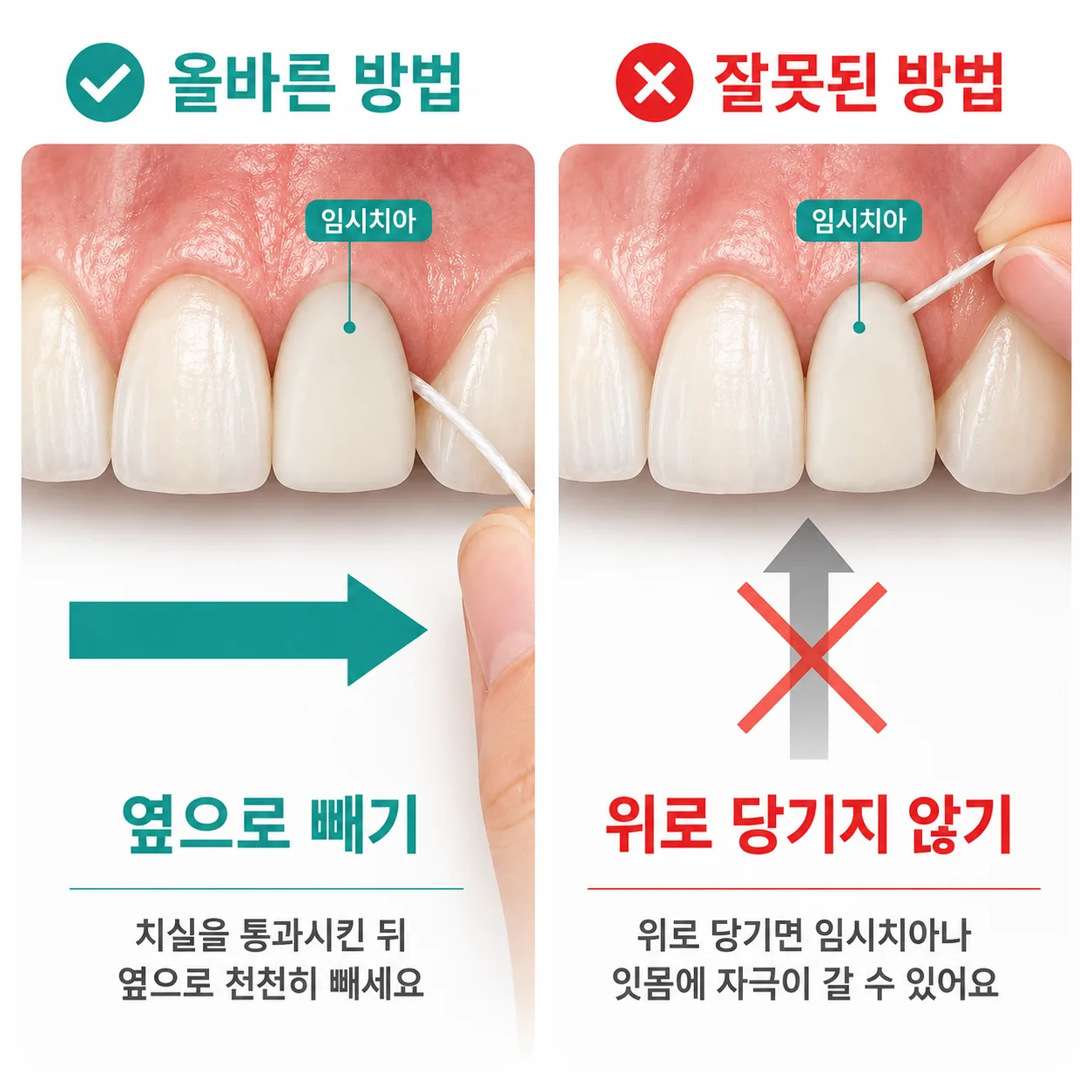 임시치아 주변 치실 사용 방향 안내