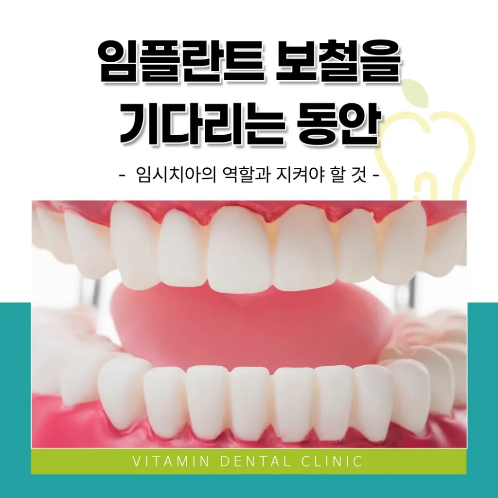 임플란트 보철을 기다리는 동안 — 임시치아의 역할과 지켜야 할 것