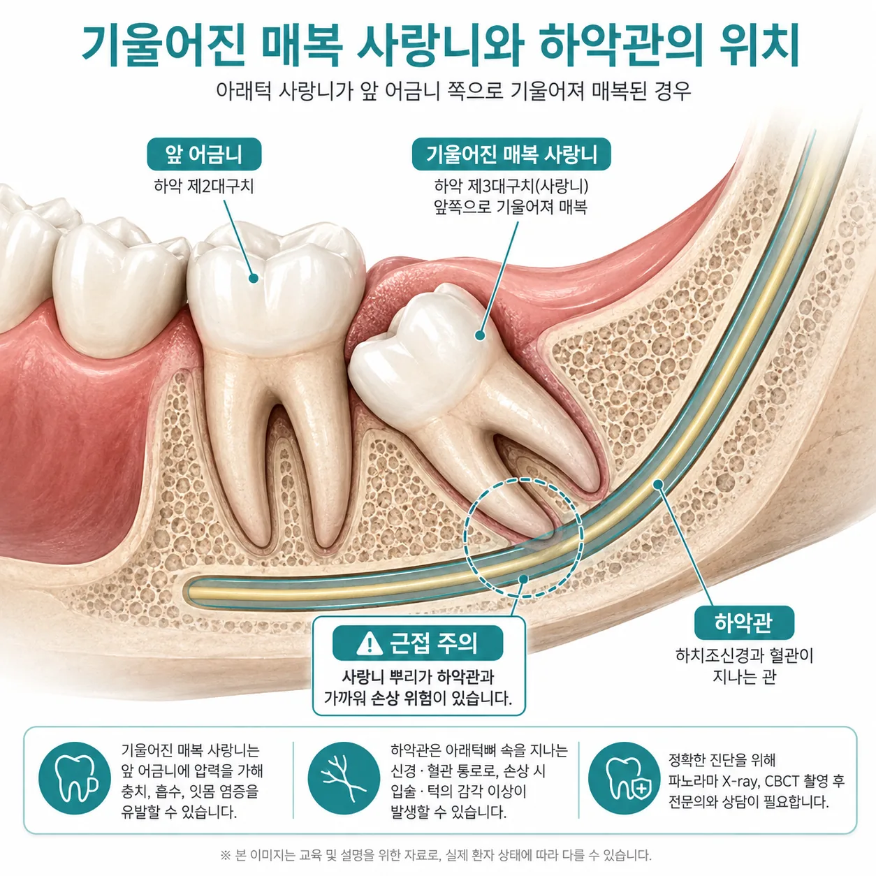 누운 사랑니와 하악관 위치를 표시한 도해