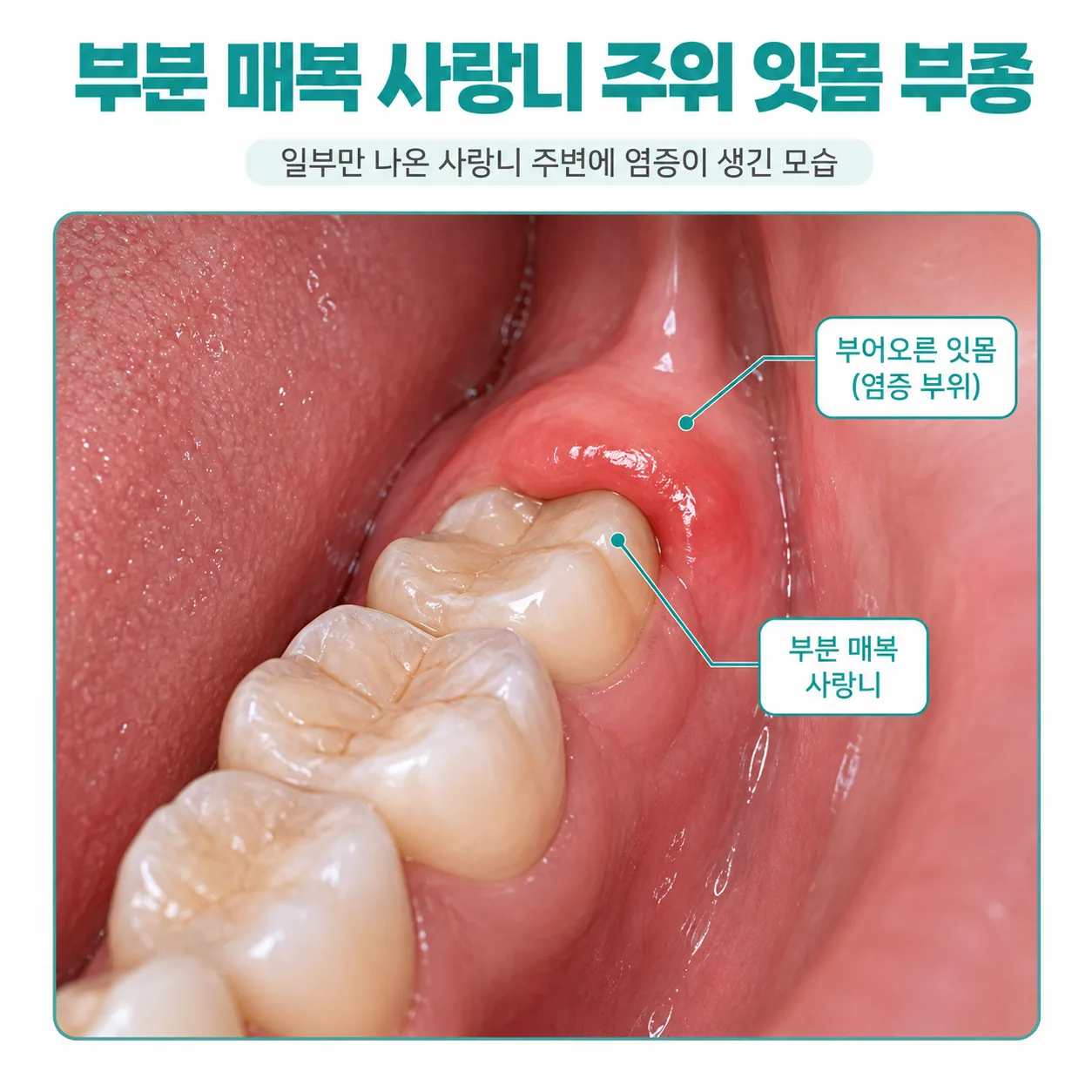일부만 맹출한 사랑니 주변 잇몸 염증